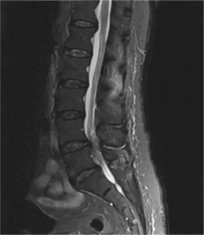Lumbar spine MRI showing lower back pathology for treatment planning